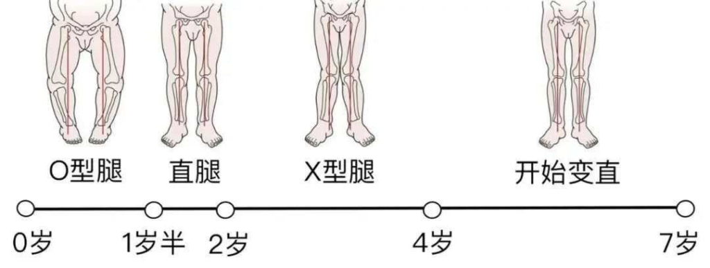 O型腿、X型腿……想让宝宝拥有完美大长腿，爸妈要知道这些！插图